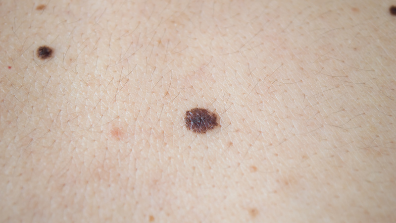 Learn More About the Best Shingles Natural Treatment for Adults