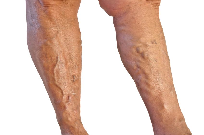 Vein Doctor in Schaumburg IL Talks About Spider & Varicose Veins Causes